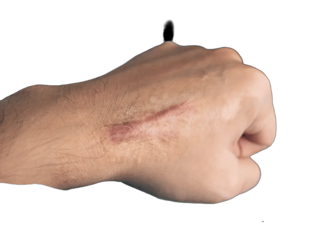 Close-up of a hand with a raised scar across the knuckles.
